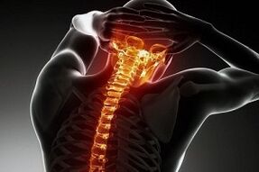 Osteokondroz ile ilişkili ağrı