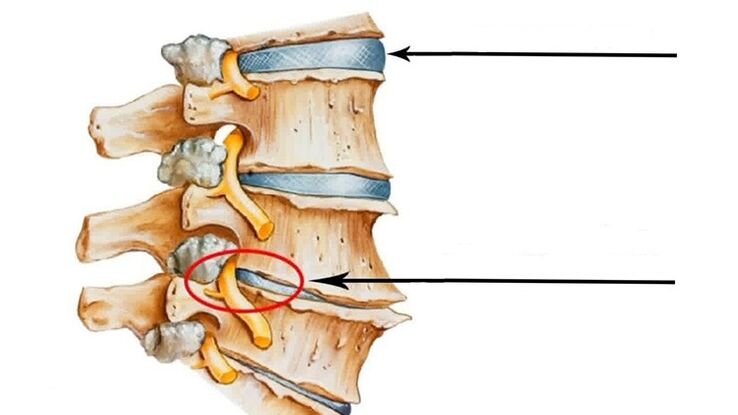 Servikal osteokondrozda omurganın yaralanması