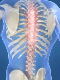 Torasik osteokondrozda spinal lezyon