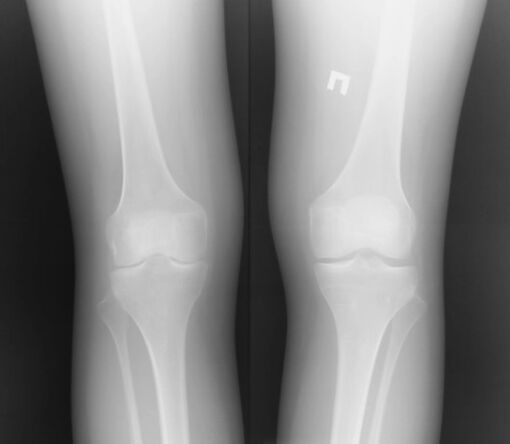 Diz ekleminin x -ray görüntüsü