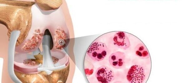 Bu, osteoartrit gelişimine yol açar