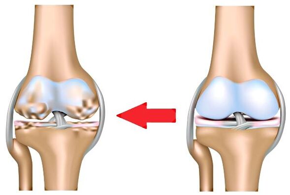 Sağlıklı eklemler ve osteoartrit