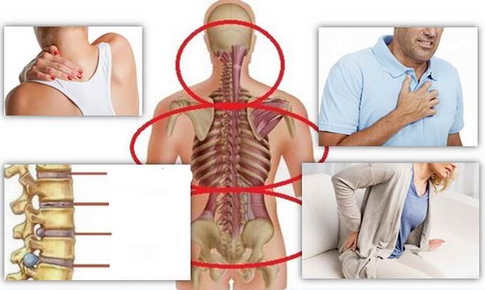 Osteokondroz için hastalık yerleri